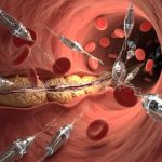 Schwedische Wissenschaftler entwickeln Nanoroboter, die Blutgefäße ohne Operation reinigen sollen.