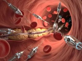 Schwedische Wissenschaftler entwickeln Nanoroboter, die Blutgefäße ohne Operation reinigen sollen.