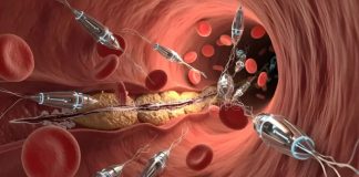 Schwedische Wissenschaftler entwickeln Nanoroboter, die Blutgefäße ohne Operation reinigen sollen.