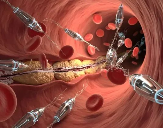 Schwedische Wissenschaftler entwickeln Nanoroboter, die Blutgefäße ohne Operation reinigen sollen.